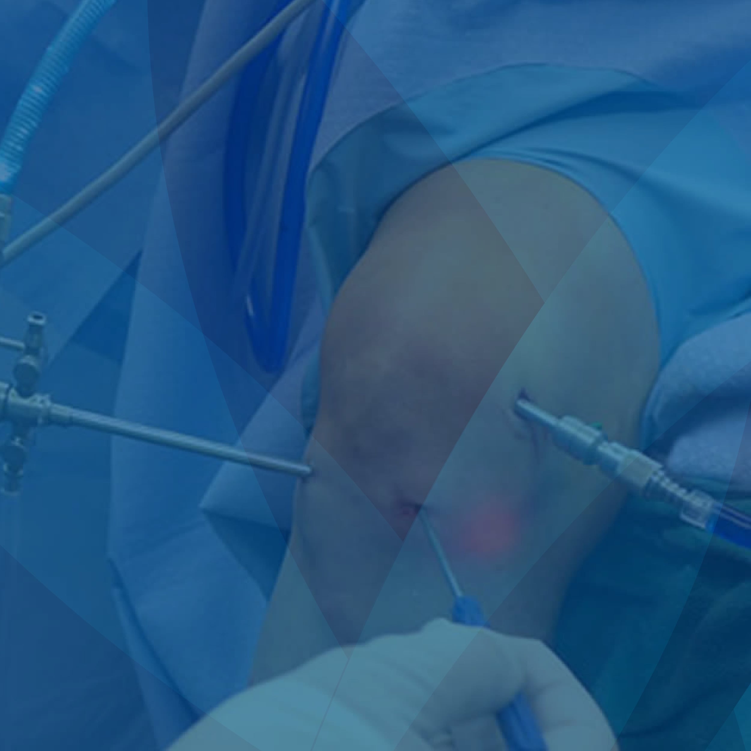 Paquete de Artroscopia de Rodilla con Reparación Ligamento Colateral Medial